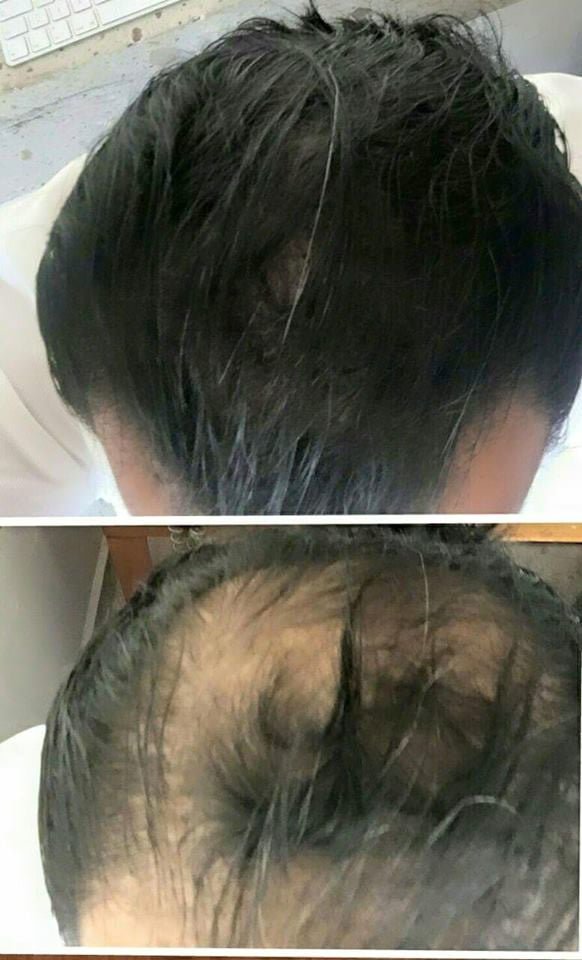 A) Kit 2 Microfibras Capilares 27.5 gr (Apariencia de más Cabello en Segundos) - Volosy, Soluciones para la calvicie.