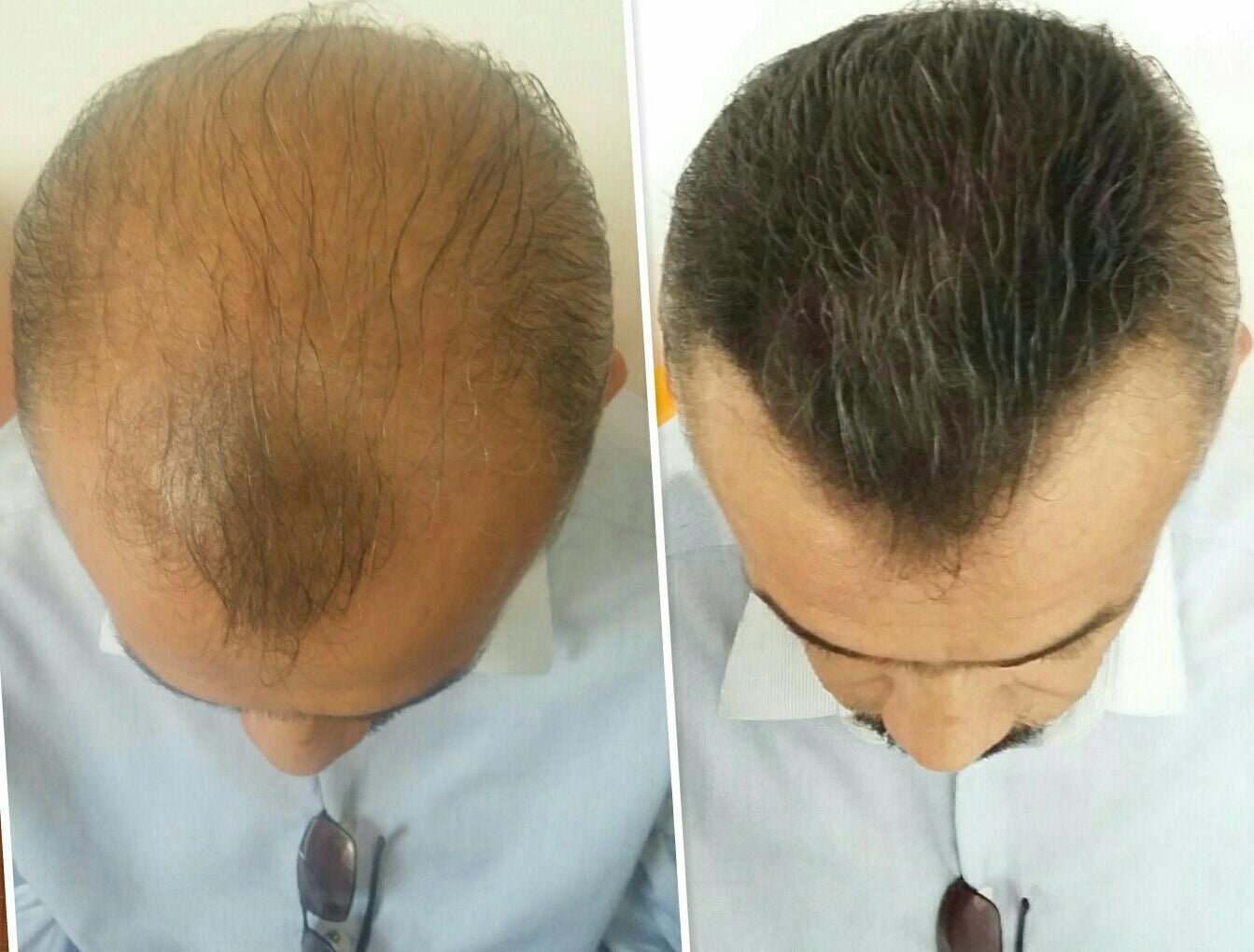 A) Kit 2 Microfibras Capilares 27.5 gr (Apariencia de más Cabello en Segundos) - Volosy, Soluciones para la calvicie.