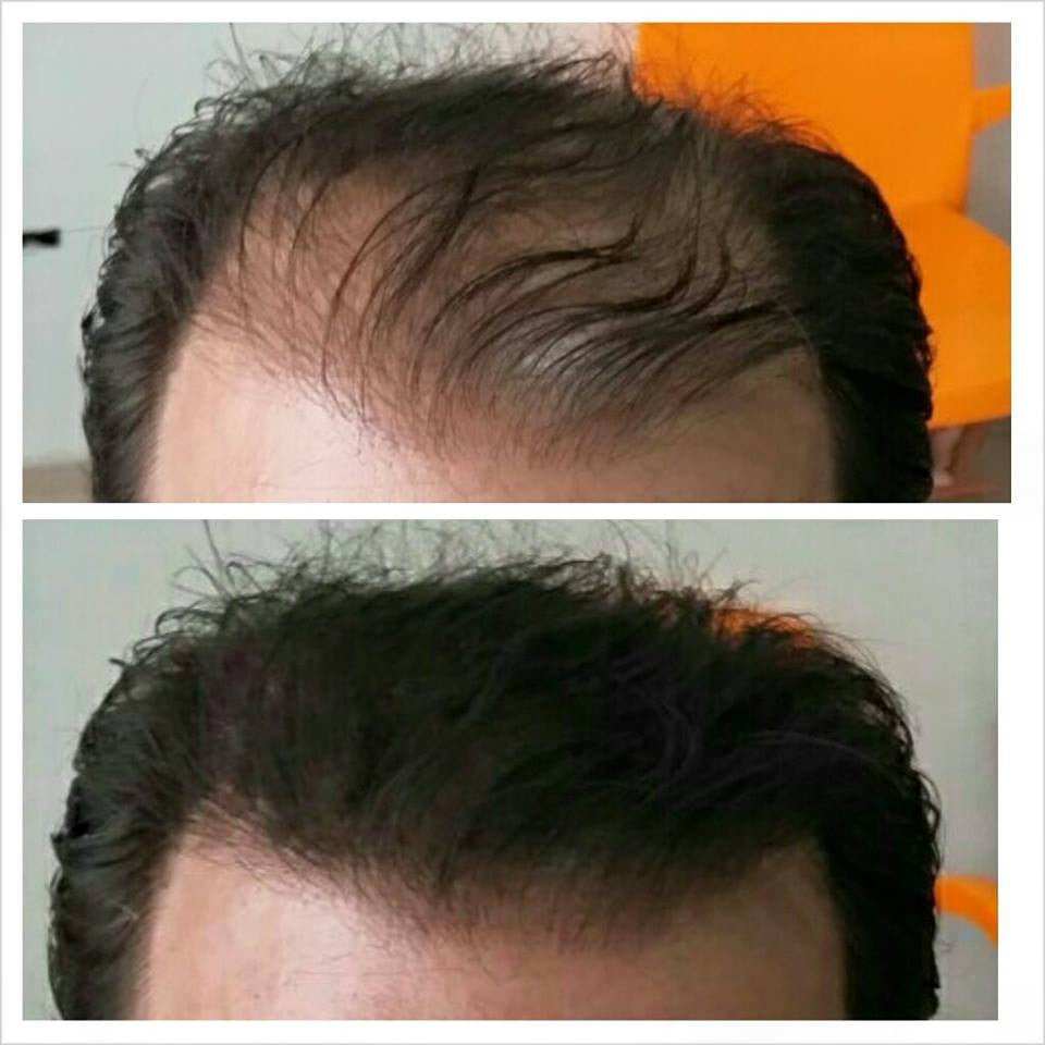 A) Kit 2 Microfibras Capilares 27.5 gr (Apariencia de más Cabello en Segundos) - Volosy, Soluciones para la calvicie.