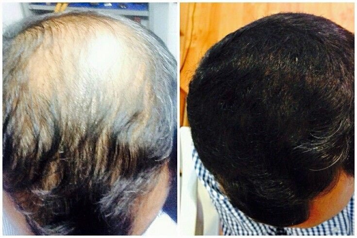 D) 1 Volosy Microfibra Capilar 27.5 gr + Bomba (Apariencia de más Cabello en Segundos) ENVÍO GRATIS - Volosy, Soluciones para la calvicie.