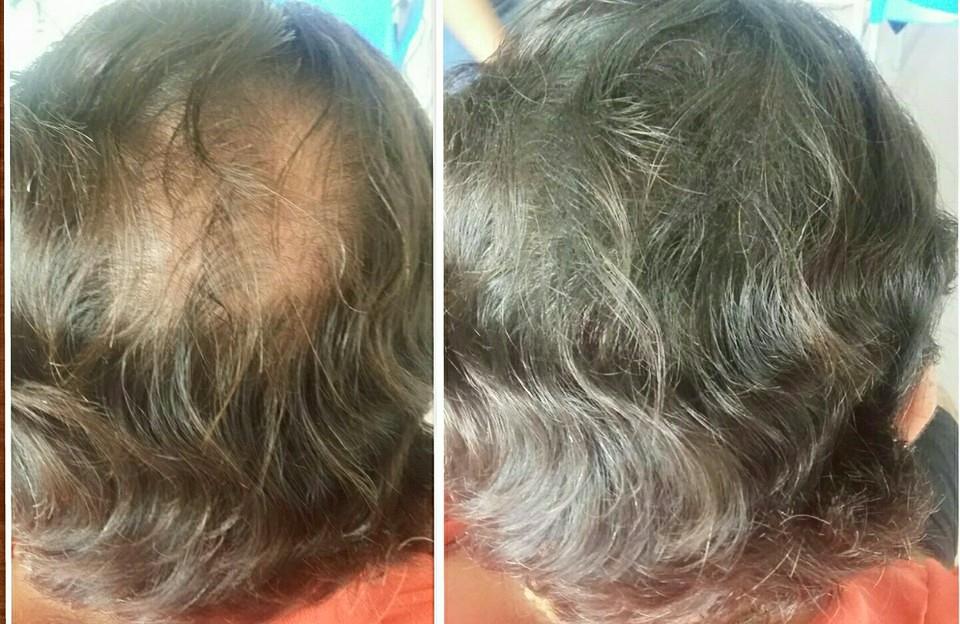 I) 2 Piezas Maquillaje Capilar Contra Agua - Apariencia de mas cabello al instante (ENVÍO GRATIS) - Volosy, Soluciones para la calvicie.