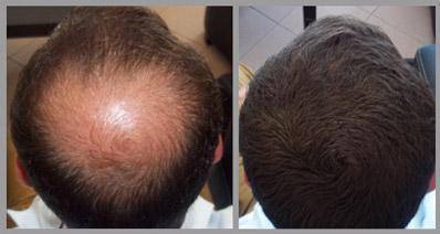 L) Minoxidil 5%, Crecimiento De Cabello,  60ml. (Rinde 1 mes)