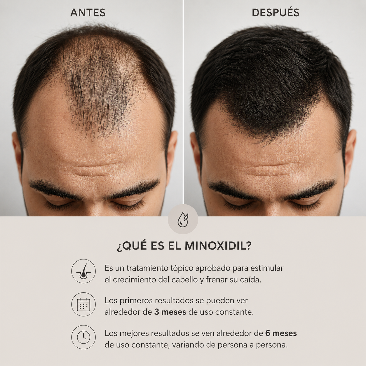 I) Minoxidil 5%, Crecimiento De Cabello,  60ml. (Rinde 1 mes)
